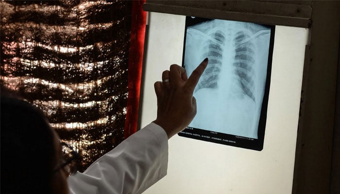 A medic examines a chest x-ray. — AFP/File