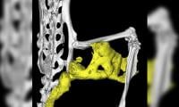 Experts Highlight Modern Treatment Options For Bone, Soft Tissue Sarcoma