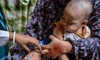 Measles Outbreak Kills More Than 500 Children In Bangladesh