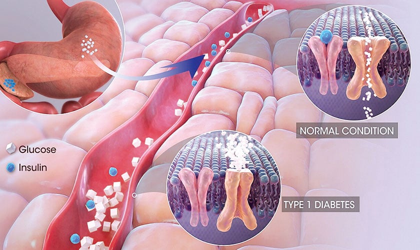 Under the knife: why diabetes changes the rules of anaesthesia