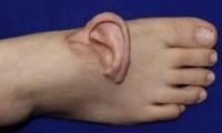 Chinese Surgeons Attach Woman’s Torn Ear To Foot To Save It  