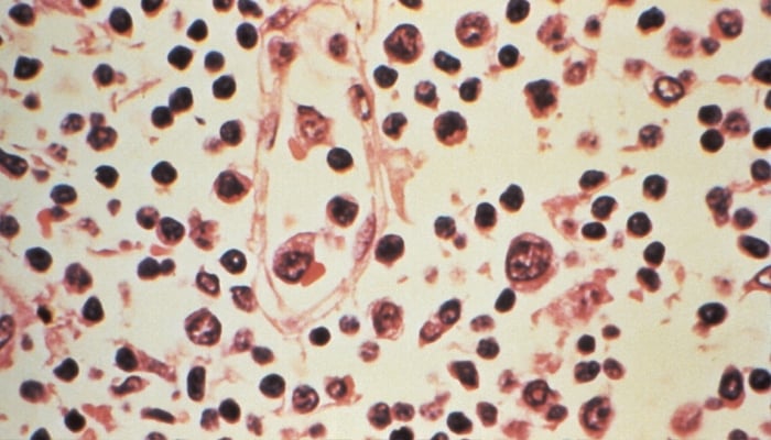Some of the cytoarchitectural features in a lymph node specimen extracted from a patient suspected of a Hantavirus illness is seen in this photo. — Reuters/File